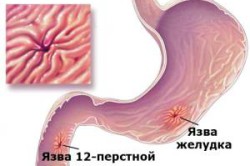 Влияние пива на желудок Влияние пива на желудок