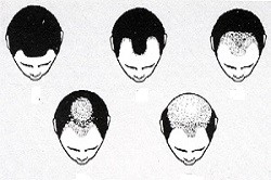 Формы выпадения волос Формы выпадения волос