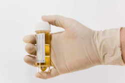 Анализ мочи Анализ мочи