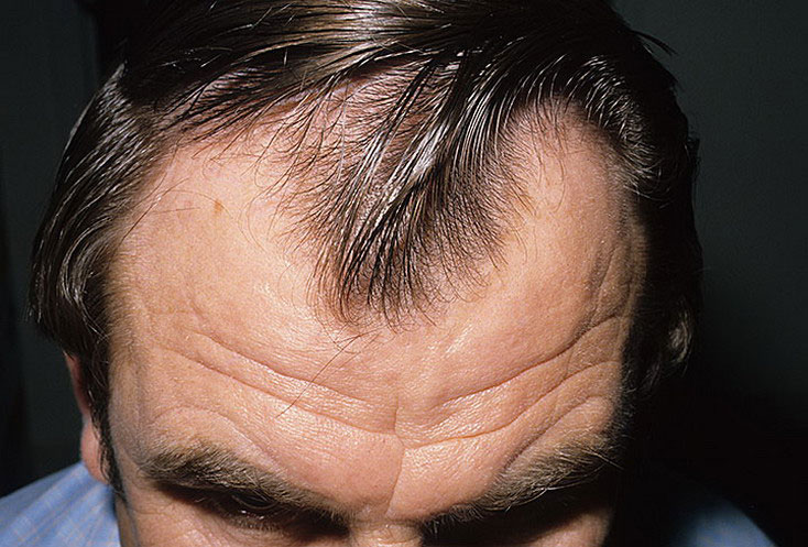 Облысение у мужчин Облысение у мужчин