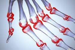 Артрит и полиартрит Артрит и полиартрит