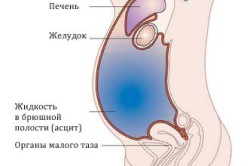 Схема асцита Схема асцита