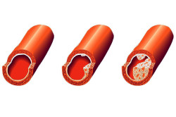Атеросклероз - образование бляшек в сосудах Атеросклероз - образование бляшек в сосудах
