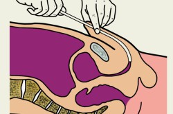 Мазок из уреты Мазок из уреты