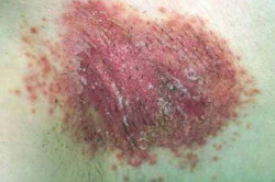 Кожа пораженная кандидозом Кожа пораженная кандидозом