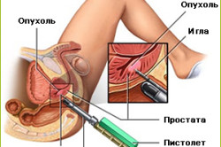 Биопсия простаты Биопсия простаты