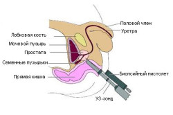 Биопсия предстательной железы Биопсия предстательной железы