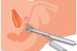 Биопсия простаты Биопсия простаты