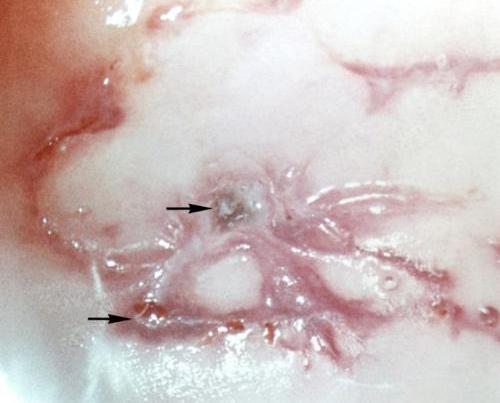 Боль в суставах ног Боль в суставах ног