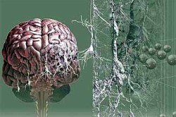 Болезнь Альцгеймера Болезнь Альцгеймера