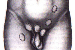 Брюшной крипторхизм Брюшной крипторхизм