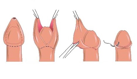 Последовательность циркумцизии