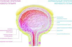 Цистит - воспаление мочевого пузыря Цистит - воспаление мочевого пузыря