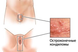 Места основного роста кондилом Места основного роста кондилом