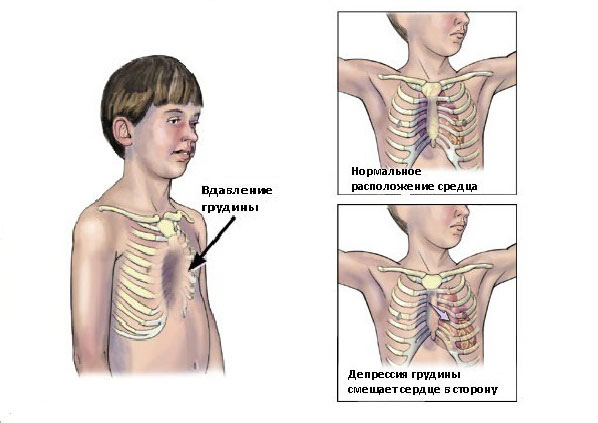 Воронкообразная деформация грудной клетки и ее влияние на сердце Воронкообразная деформация грудной клетки и ее влияние на сердце