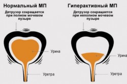 Детрузор мочевого пузыря