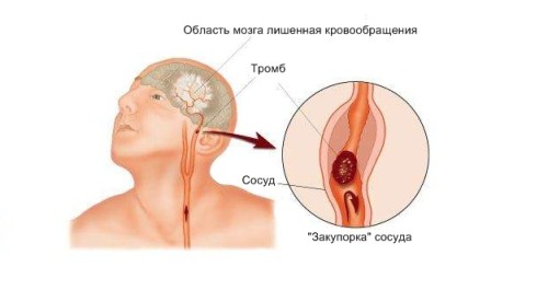 Ишемический инсульт Ишемический инсульт
