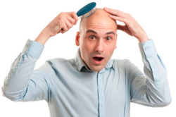 Облысение Облысение