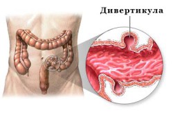 Дивертикулярная болезнь divert