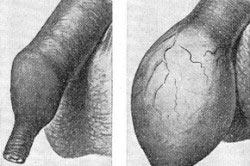 Фимоз крайней плоти Фимоз крайней плоти
