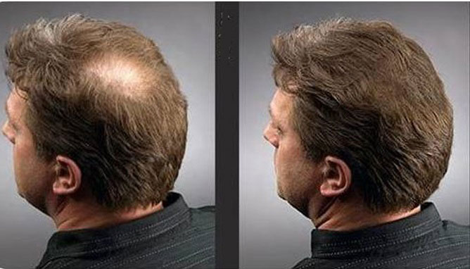 Пересадка волос Пересадка волос