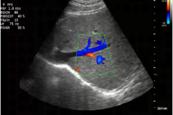Допплерография сосудов Допплерография сосудов