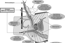 Процедура электростимуляции простаты Процедура электростимуляции простаты