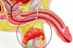 Эпидидимит Эпидидимит