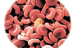 Кровь при эритремии под микроскопом Кровь при эритремии под микроскопом