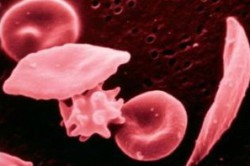 Кровь под микроскопом при эритроцитозе Кровь под микроскопом при эритроцитозе