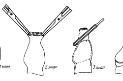 Схема этапов обрезания крайней плоти Схема этапов обрезания крайней плоти