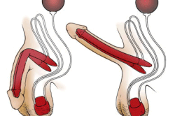 Фаллопротезирование Фаллопротезирование