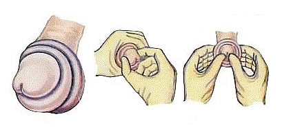 Растягивание крайней плоти Растягивание крайней плоти