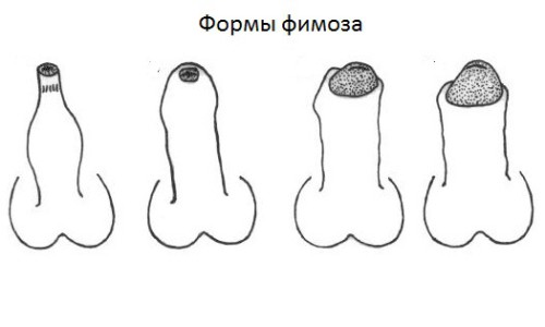 Степени развития фимоза Степени развития фимоза