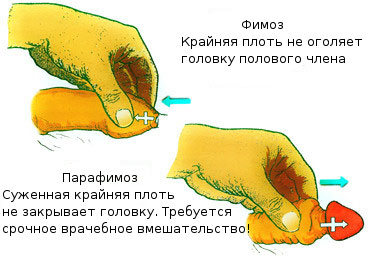 Строение пениса при фимозе: половой член, головка полового члена, крайняя плоть, мошонка Строение пениса при фимозе: половой член, головка полового члена, крайняя плоть, мошонка
