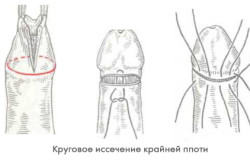 Обрезание крайней плоти Иссечение крайней плоти