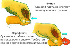 Фимоз и парафимоз Фимоз и парафимоз