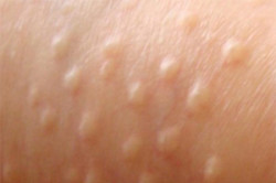 Гранулы Фордайса Гранулы Фордайса