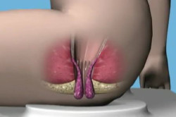 Запущенный геморрой gem