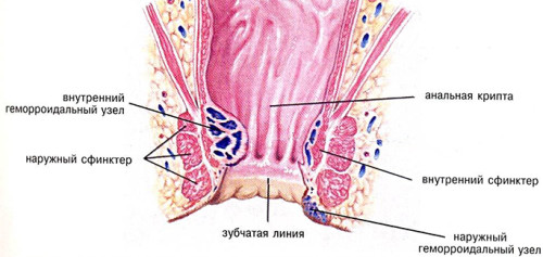 Геморрой у мужчин Геморрой у мужчин
