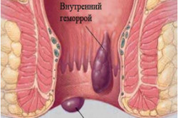 Геморрой gemor