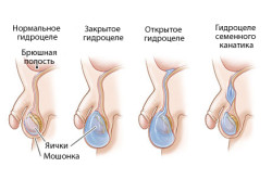 Гидроцеле Гидроцеле