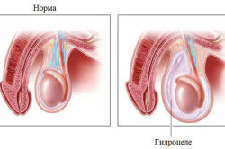 Норма и гидроцеле яичка Норма и гидроцеле яичка