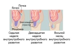 Гидроцеле у новорожденных Гидроцеле у новорожденных
