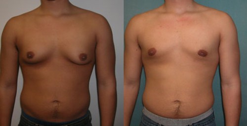 Гинекомастия Гинекомастия