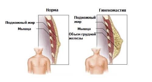 Гинекомастия Гинекомастия