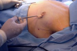 Операция гинекомастия