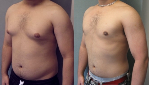 Гинекомастия Гинекомастия