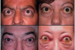 Проявление экзофтальма при гипертиреозе Проявление экзофтальма при гипертиреозе