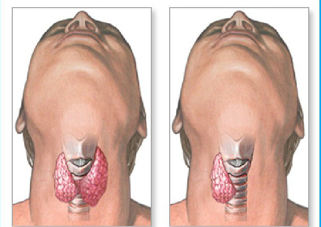 Гипертиреоз Гипертиреоз